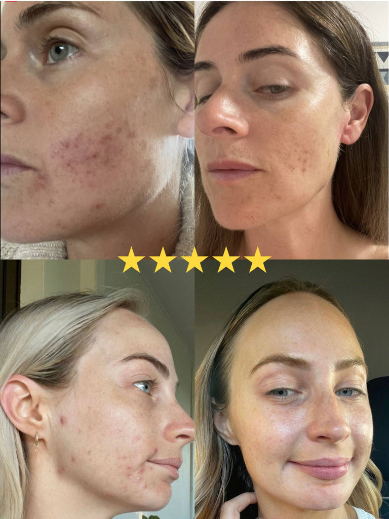 acne scarring treatment